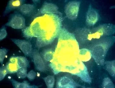 Αναπνευστικός συγκυτιακός ιός: Αίτια και συμπτώματα της ασθένειας που «χτυπάει» τα παιδιά